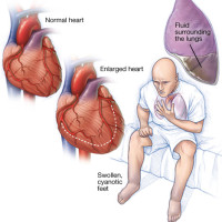 Insuficiența cardiacă – „o bombă cu efect lent”