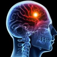 Accidentul vascular cerebral: simptome și factori de risc