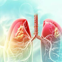 24 martie 2024 – Ziua mondială de luptă împotriva tuberculozei
