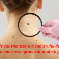 Lunarul de conștientizare a cancerului de piele: ,,Cancerul de piele este grav, dar poate fi prevenit”